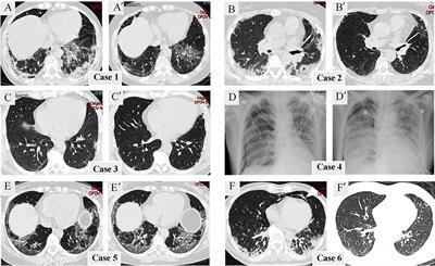 The clinical features and prognoses of anti-MDA5 and anti-aminoacyl-tRNA synthetase antibody double-positive dermatomyositis patients